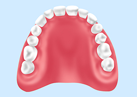 レジン床義歯