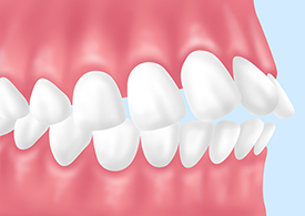 上下顎前突（じょうげがくぜんとつ）