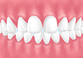 空隙歯列（くうげきしれつ）