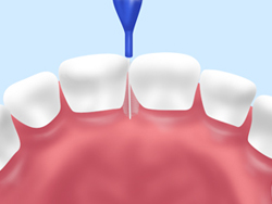 歯間ブラシ